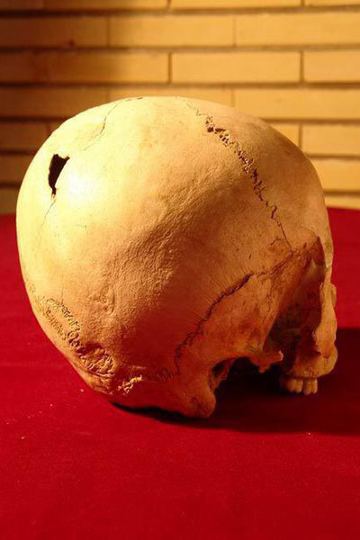 سیر تکامل جراحی مغز؛ از سنگ و مته تا ربات‌های ناجی/ اولین جراحی موفق مغز به چه زمانی برمی‌گردد؟/ سوراخ‌کردن مغز به قصد خروج ارواح خبیث!
